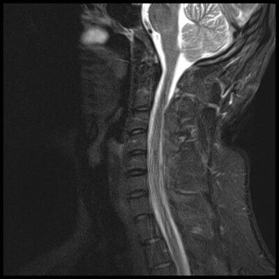 MRI motion artifact c spine MRI motion artifact c spine