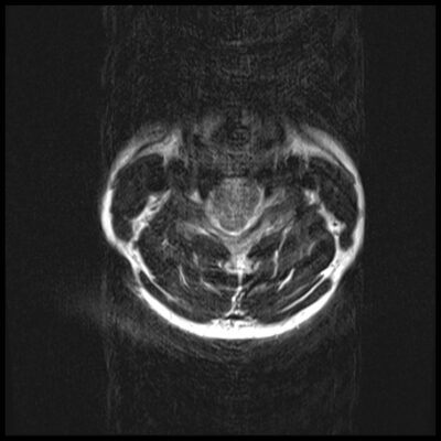 MRI motion artifact c spine MRI motion artifact c spine