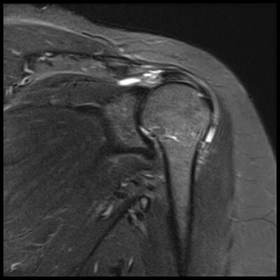 MRI motion artifact shoulder MRI motion artifact shoulder