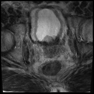 MRI motion artifact pelvis MRI motion artifact abdomen t2