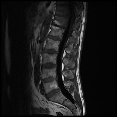 dielectric effect artifact spine dielectric effect artifact spine 3T