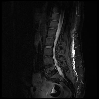 dielectric effect artifact spine 3T dielectric effect artifact spine sag 3T