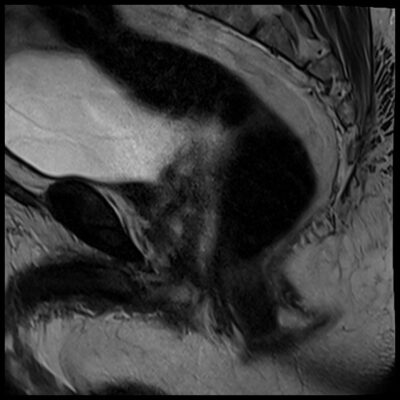 MRI motion artifact pelvis sagittal MRI motion artifact pelvis sagittal