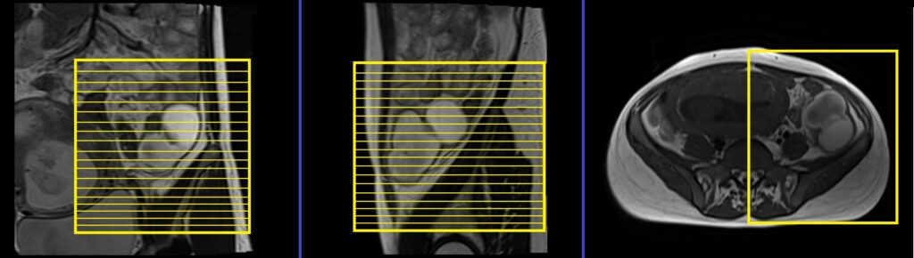 Adnexal Masses in Pregnancy MRI axial SFOV planning and protocol