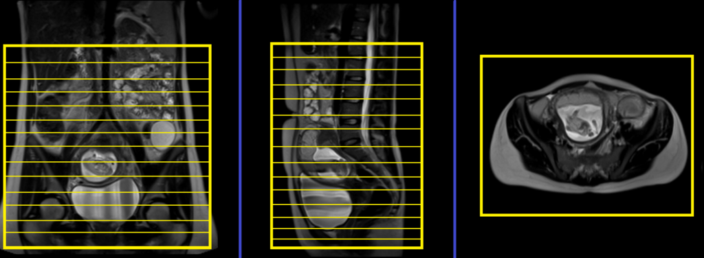 Adnexal Masses in Pregnancy MRI axial big fov planning and protocol