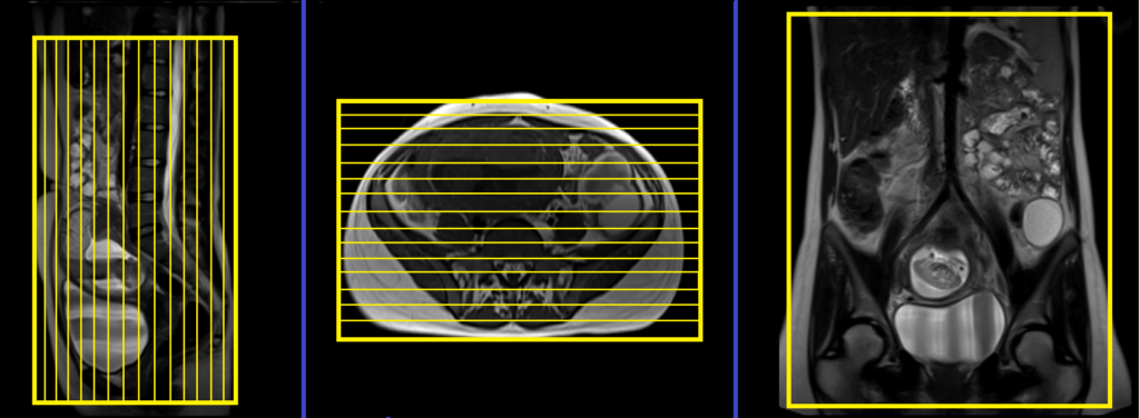 Adnexal Masses in Pregnancy MRI coronal big fov planning and protocol