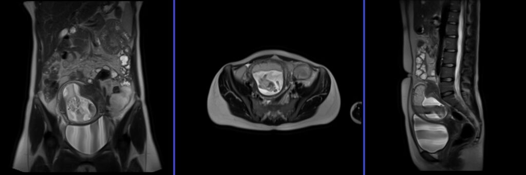 Adnexal Masses in Pregnancy MRI localiser