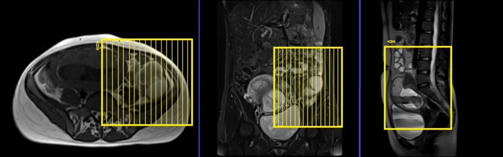 Adnexal Masses in Pregnancy MRI sagittal SFOV planning and protocol