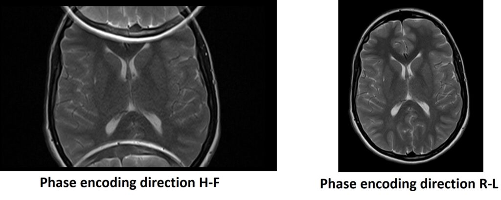 Aliasing or wrap around artifact mri avoid using phase swap