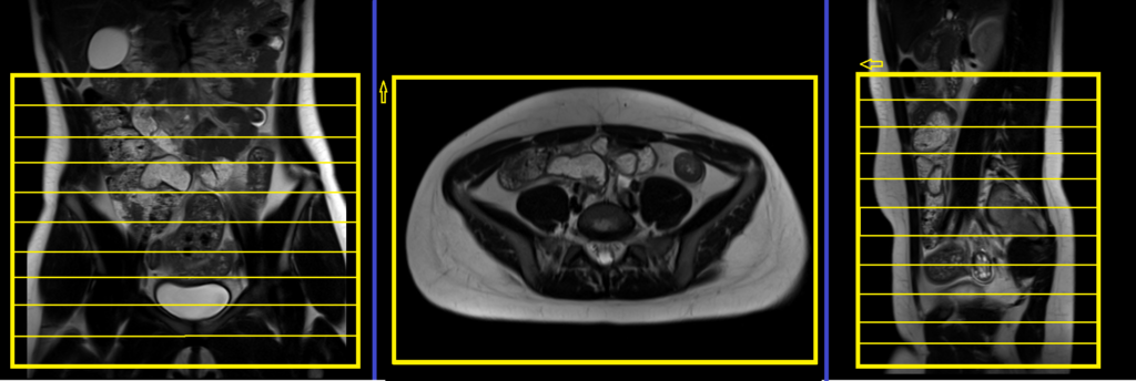 Appendix mri planning and protocol of axial big fov scans