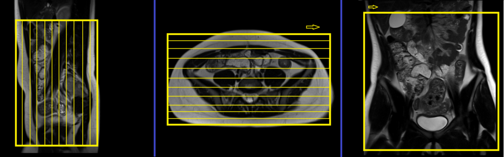 Appendix mri planning and protocol of coronal big fov scans