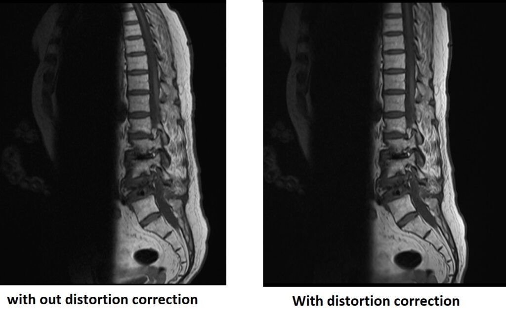 Artifact reduction using distortion correction algorithms