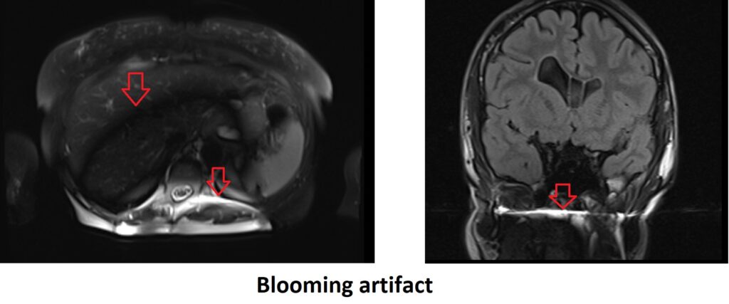 Blooming artifact MRI