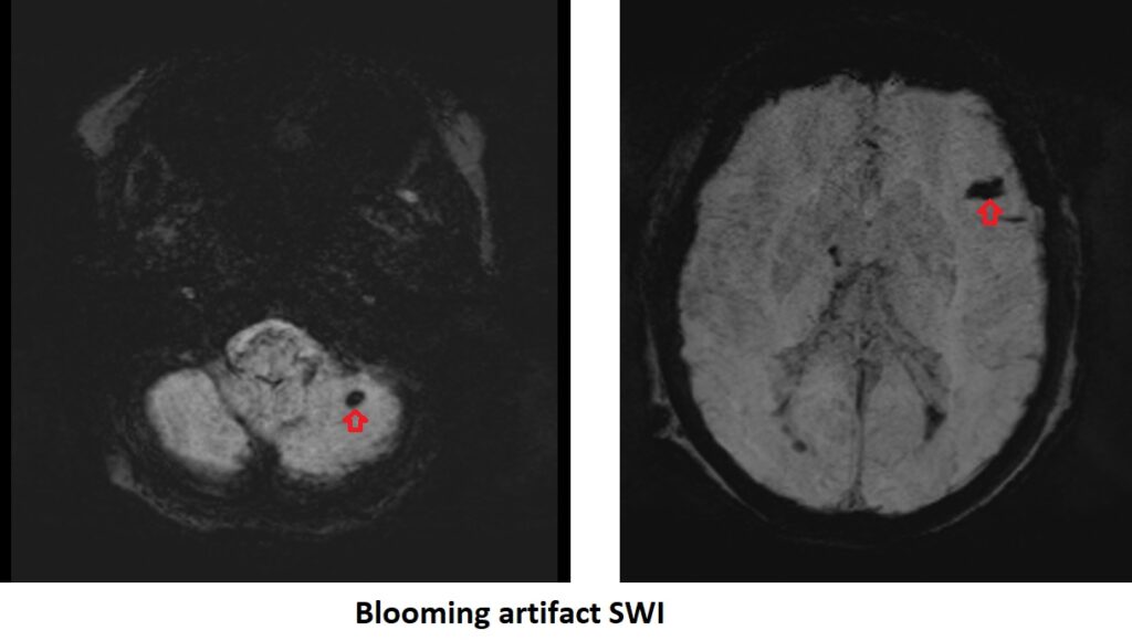Blooming artifact SWI