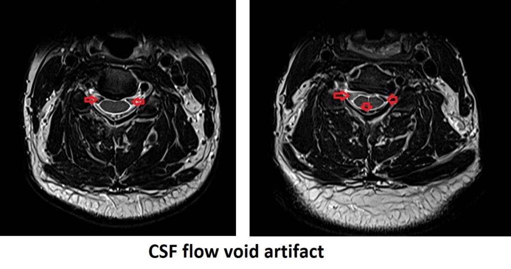 CSF Flow void artifact