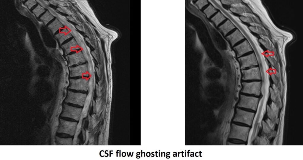 CSF flow ghosting artifact