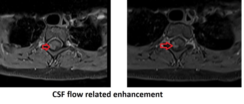 CSF flow related enhancement artifact