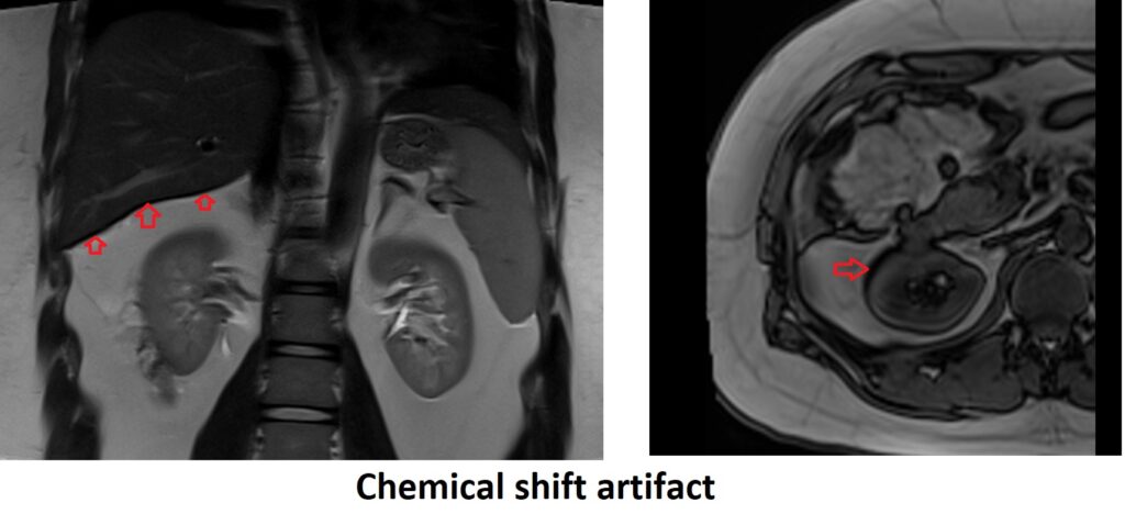Chemical shift artifact MRI