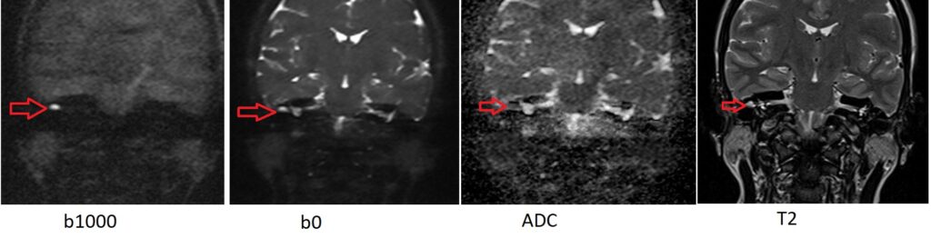 Cholesteatoma MRI apperance