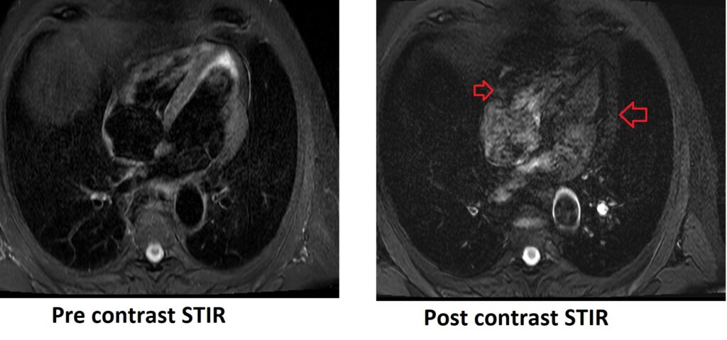 Contrast media artifacts in MRI