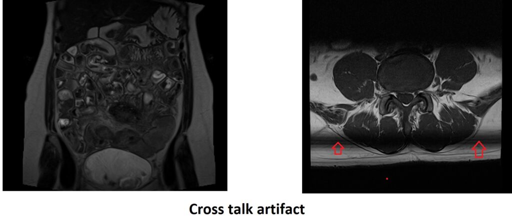 Cross talk artifact