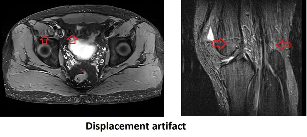 Displacement artifact MRI flow artifact
