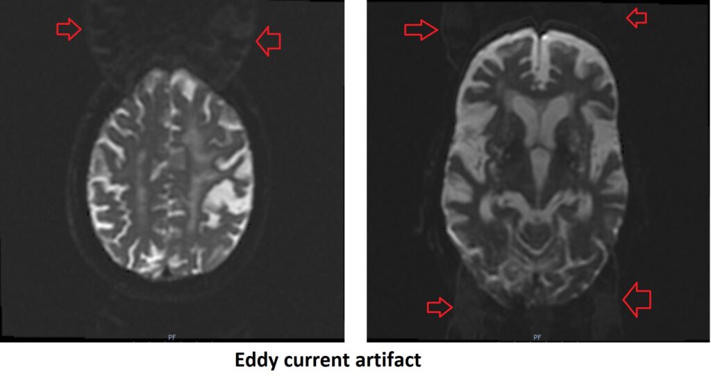 Eddy current artifact MRI