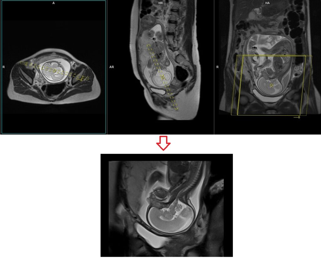 Fetal brain MRI planning of sagittal localiser image