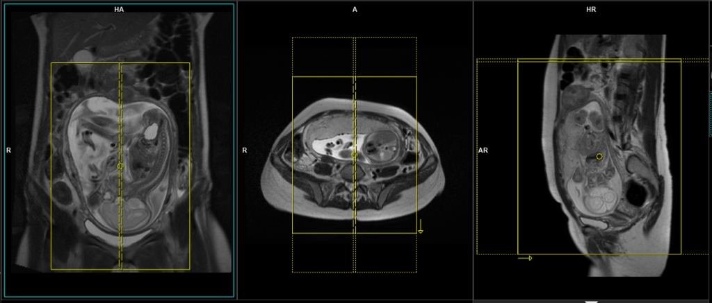 Fetal mri large FOV sagittal planning
