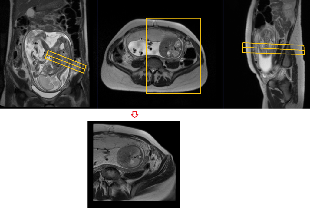 Fetal spine MRI planning of axial localiser image