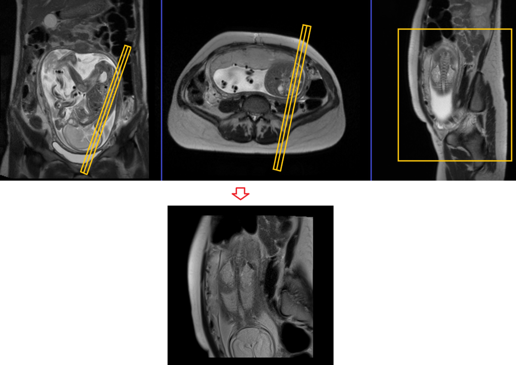 Fetal spine MRI planning of coronal localiser image