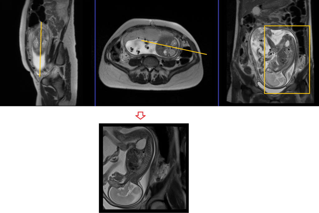 Fetal spine MRI planning of sagittal localiser image