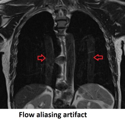 Flow Aliasing artifact MRI Flow Aliasing artifact MRI