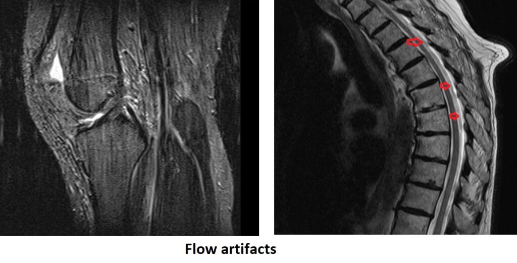 Flow artifacts mri