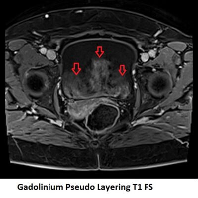 Gadolinium Pseudo Layering T1 Gadolinium Pseudo Layering T1