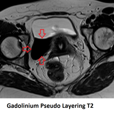 Gadolinium Pseudo Layering artefact t2 image Gadolinium Pseudo Layering artefact t2 image