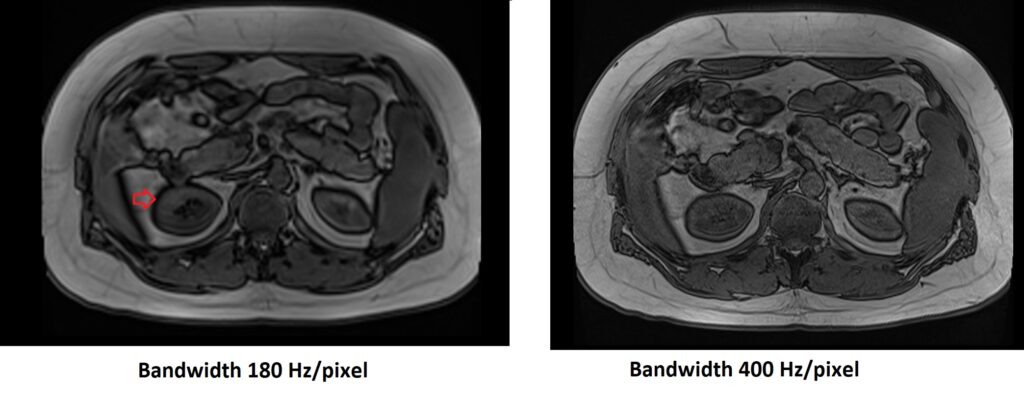 Increase receiver bandwidth to reduce the impact of chemical shift artifact