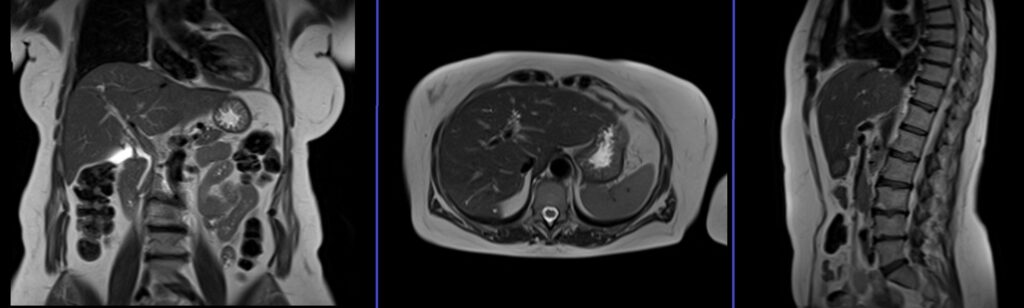 Liver MRI localiser planning and protocol image