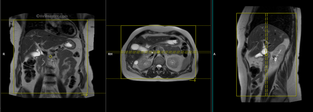 MRCP planning of coronal slices