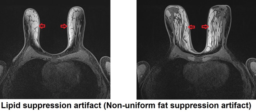 MRI Lipid suppression artifact (Non-uniform fat suppression artifact)