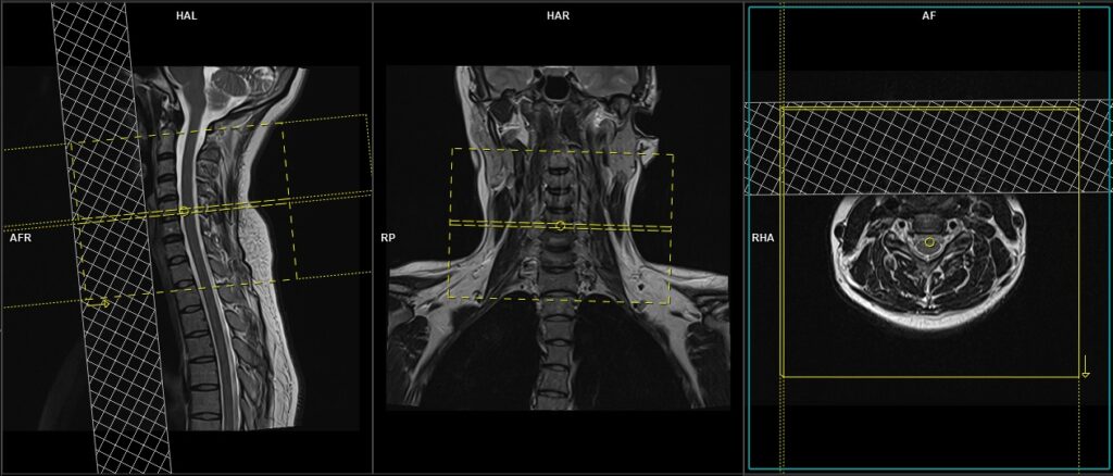 MRI PANING OF C SPINE AXIAL