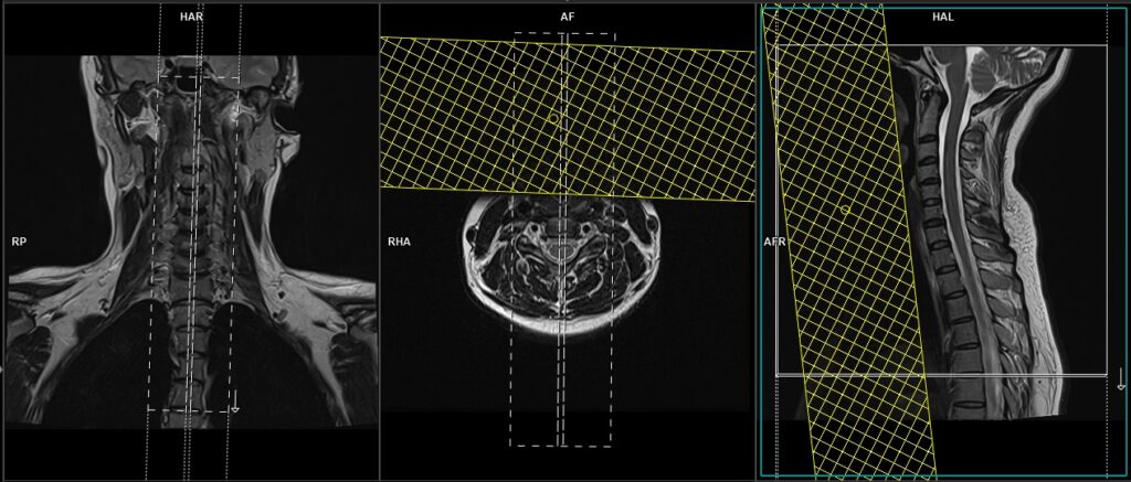MRI PANING AND PROTOCOL OF C SPINE SAGITTAL