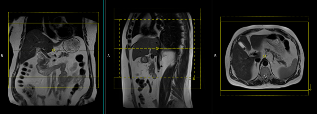 MRI liver planning and protocol of axial 3D T1 images