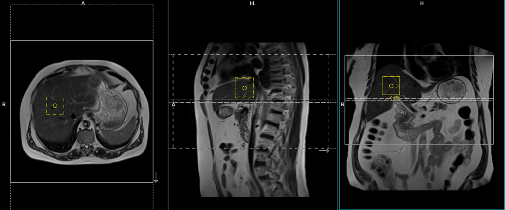 MRI liver planning and protocol of axial respiratory gated scans