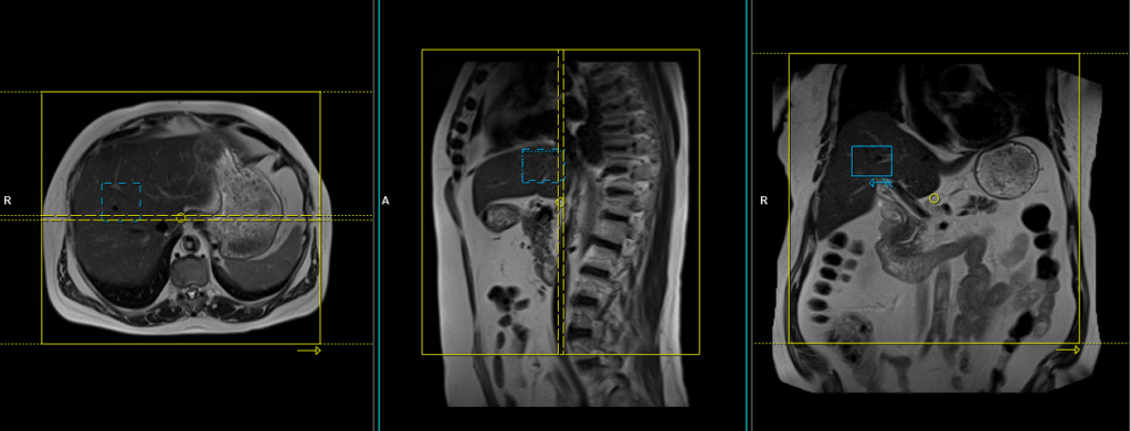 MRI liver planning and protocol of axial respiratory gated scans