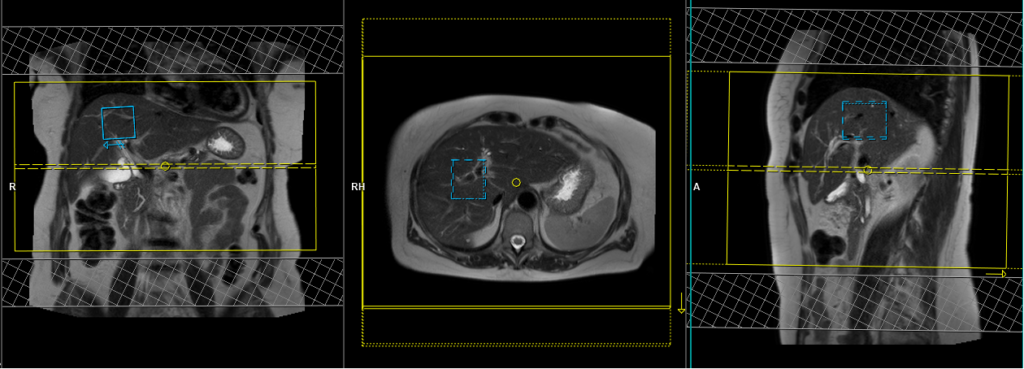 Magnetic resonance cholangiopancreatography (MRCP) MRI protocol and planning of axial respiratory gated scans