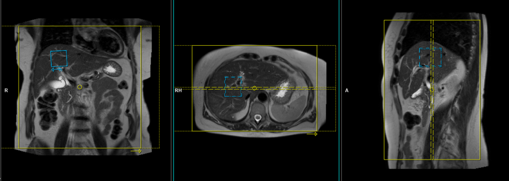 Magnetic resonance cholangiopancreatography (MRCP) MRI protocol and planning of coronal respiratory gated scans