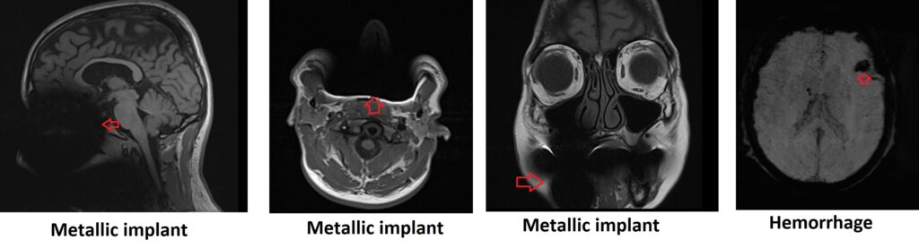 Magnetic susceptibility artifact MRI