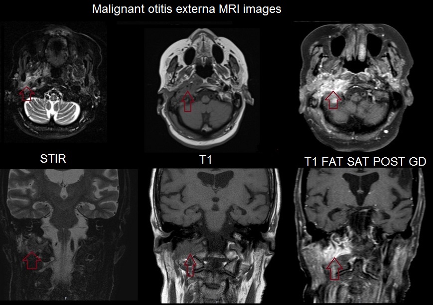 Malignant otitis externa (skull base osteomyelitis ) MRI images