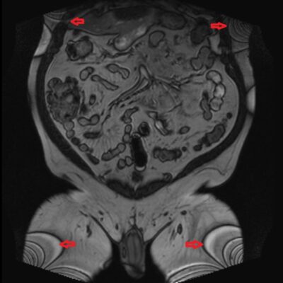 Moiré fringes MRI artifact Moiré fringes MRI artifact